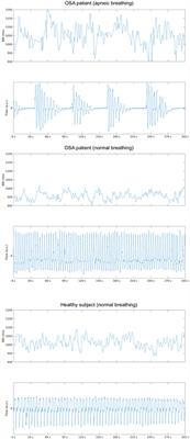 The Different Facets of Heart Rate Variability in Obstructive Sleep Apnea